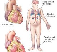 Understanding Swelling in Congestive Heart Failure: Causes, Symptoms, and Management Understanding Swelling in Congestive Heart Failure: Causes, Symptoms, and Management